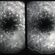 Recurrent Pseudotumor